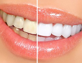 Before and after teeth whitening
