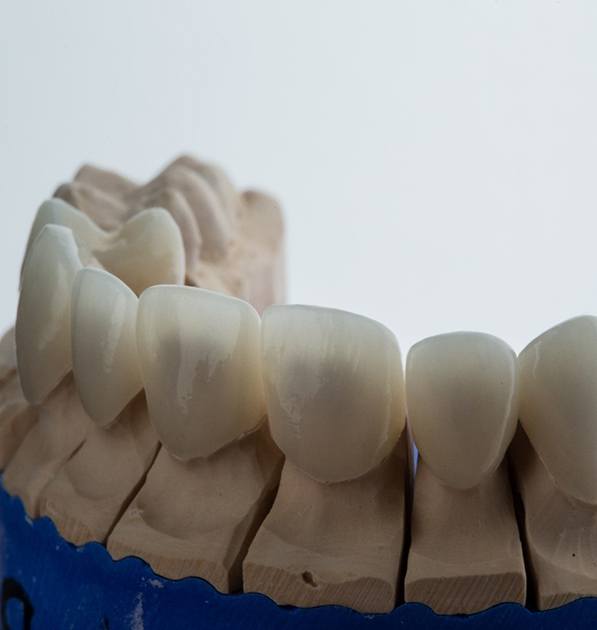 dental bridge placed on a model of a mouth