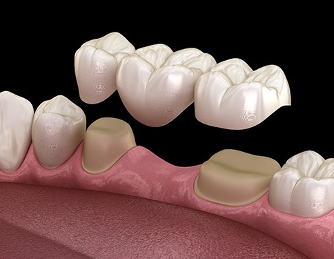 computer illustration of a dental bridge being placed