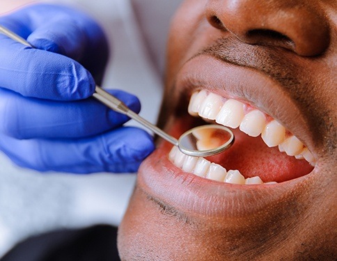 Closeup of perfect smile after dental crown placement