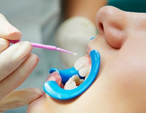 Patient receiving fluoride treatment