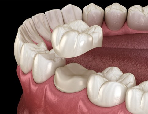3D render of a dental crown