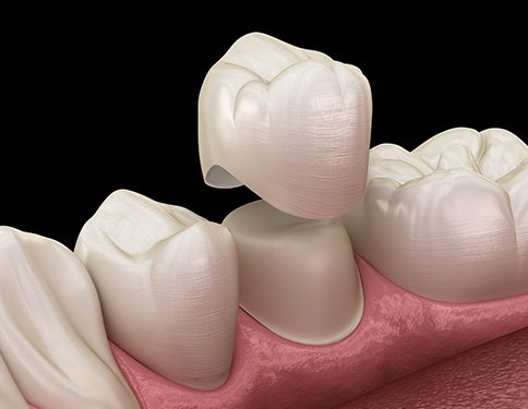 Animated dental crown placement