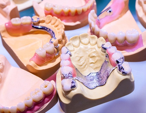 models of partial dentures 