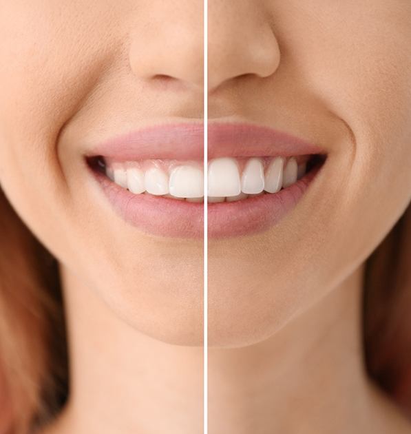 A woman’s smile before and after gum recontouring