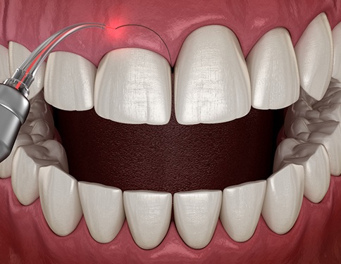 A CGI of a gum recontouring procedure