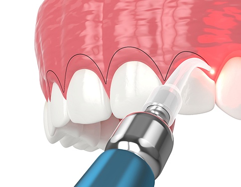 A CGI of a laser gum recontouring procedure