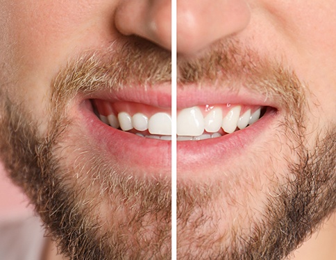 A man before and after gum recontouring
