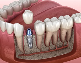 dental implant fused with the jawbone and topped with a crown 