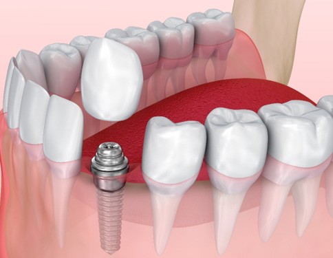 Digital illustration that shows a placed dental implant