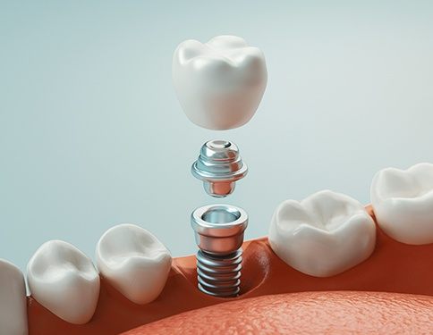 Animated dental implant tooth replacement process