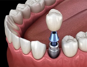 Animated implant supported dental crown placement