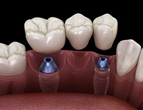 Animated implant supported fixed bridge placement