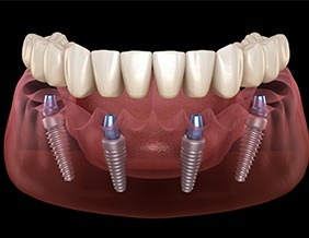 Animated implant supported denture