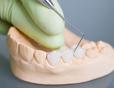 Model smile with fixed bridge restoration