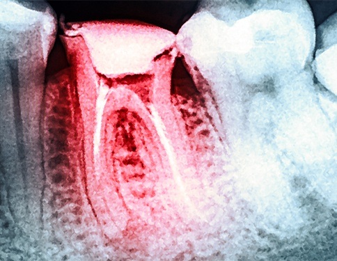 X-ray of root canal treated tooth