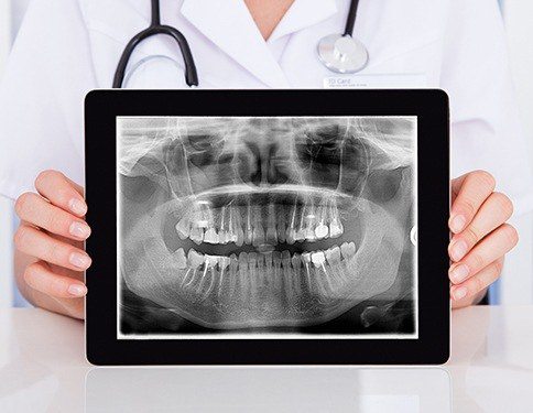 Panoramic dental x-rays