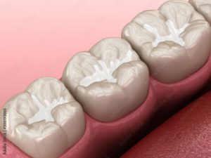 Computer image of dental sealants.