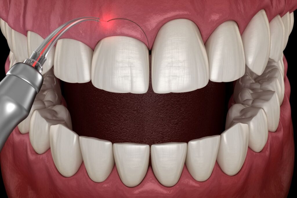 A CGI of a laser gum recontouring treatment